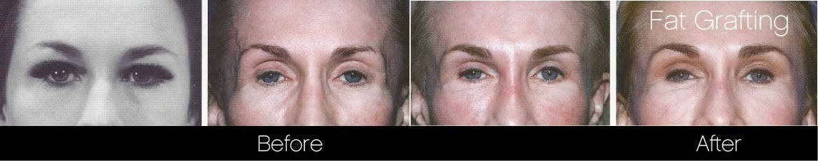 facial fat grafting before and after