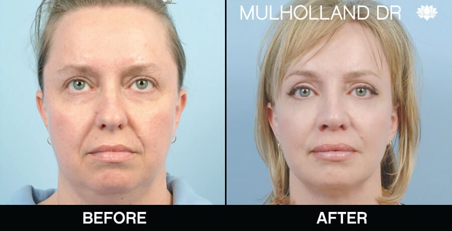 facial fat grafting before and after