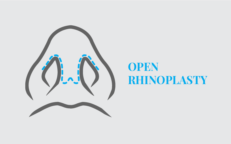 Shows a rhinoplasty method where incisions are made externally for better visibility.