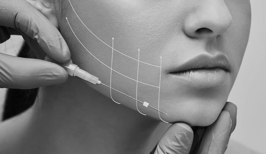 A doctor performing a Thread Lift procedure on a woman's face with lifting lines marked on the skin.