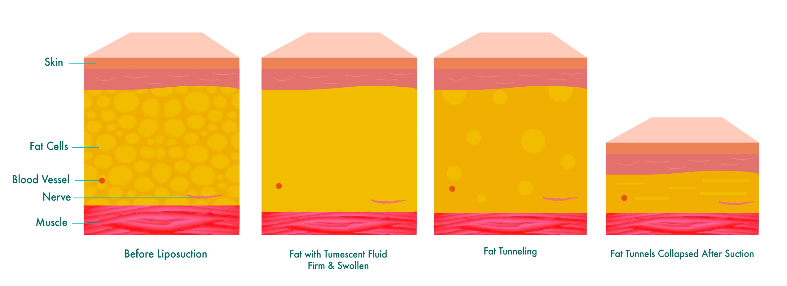 Illustration of the Tumescent Liposuction process with four stages.