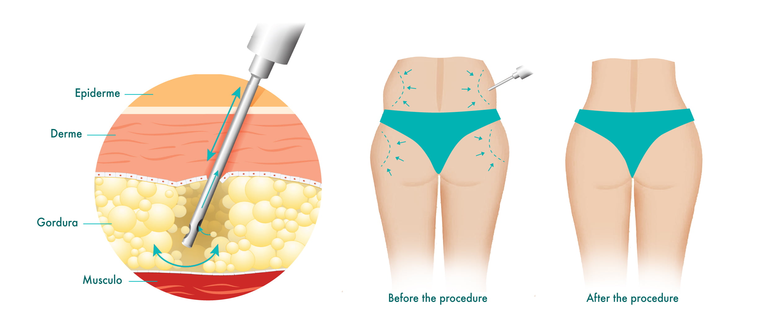 Before and after illustration of Vaser Liposuction in Toronto, showcasing the results of the procedure.