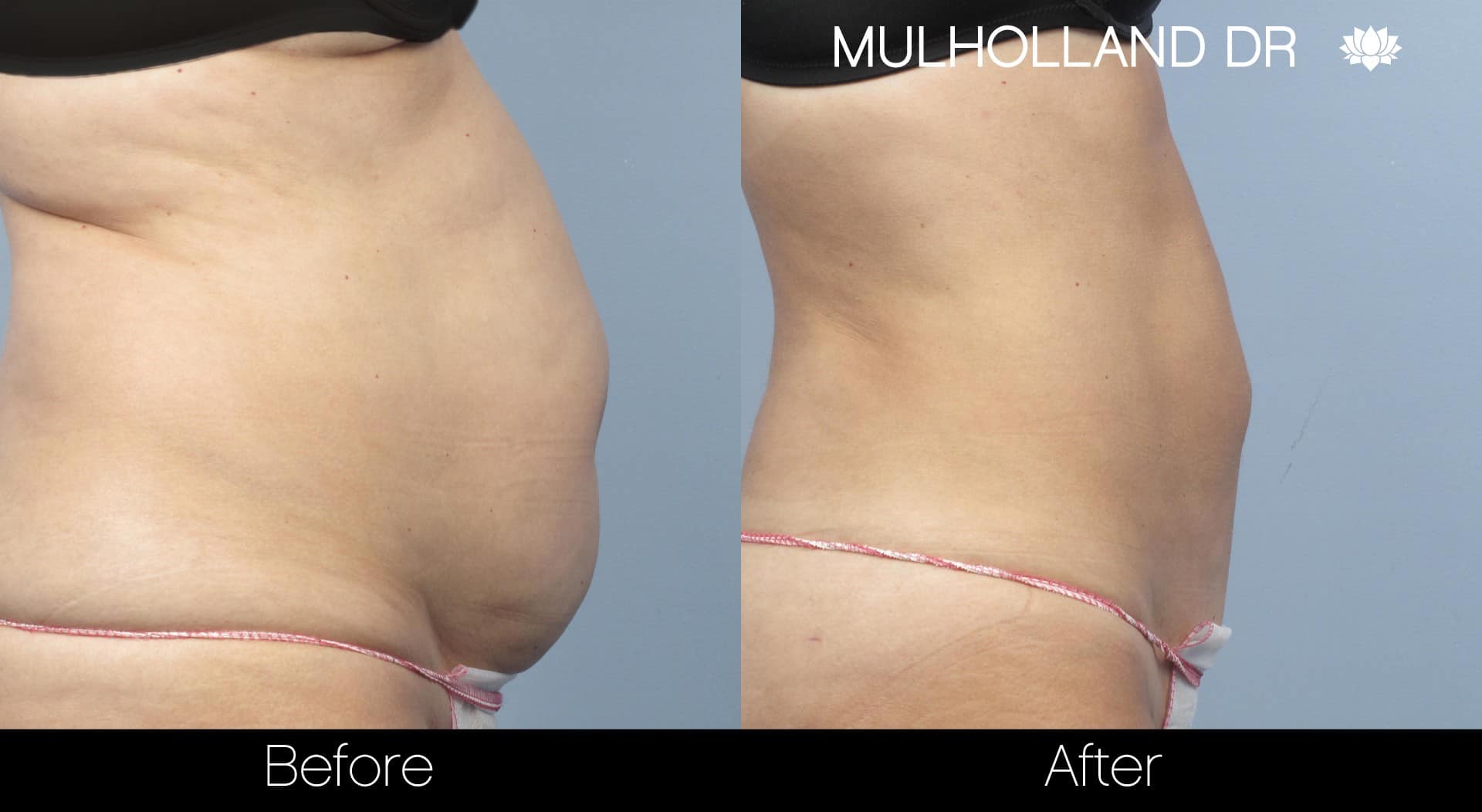 Side view showing the before and after results of tumescent liposuction on the abdomen and waist.